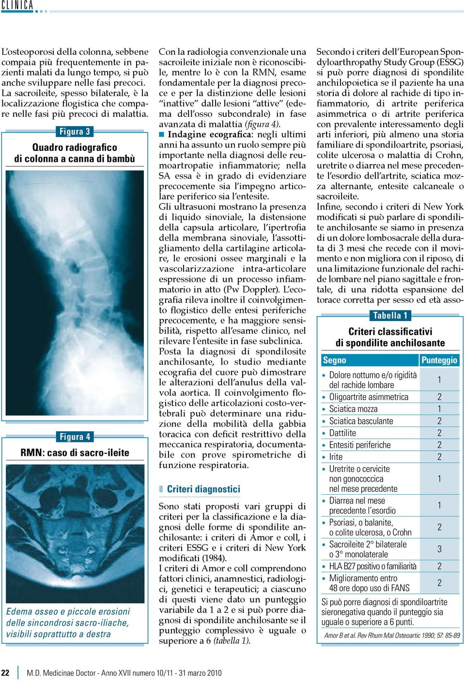 Figura 3 Quadro radiografico di colonna a canna di bambù Figura 4 RMN: caso di sacro-ileite Edema osseo e piccole erosioni delle sincondrosi sacro-iliache, visibili soprattutto a destra Con la