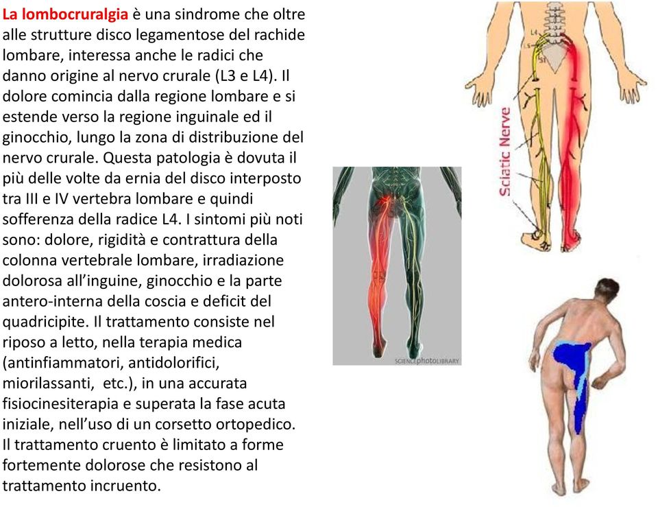 Questa patologia è dovuta il più delle volte da ernia del disco interposto tra III e IV vertebra lombare e quindi sofferenza della radice L4.