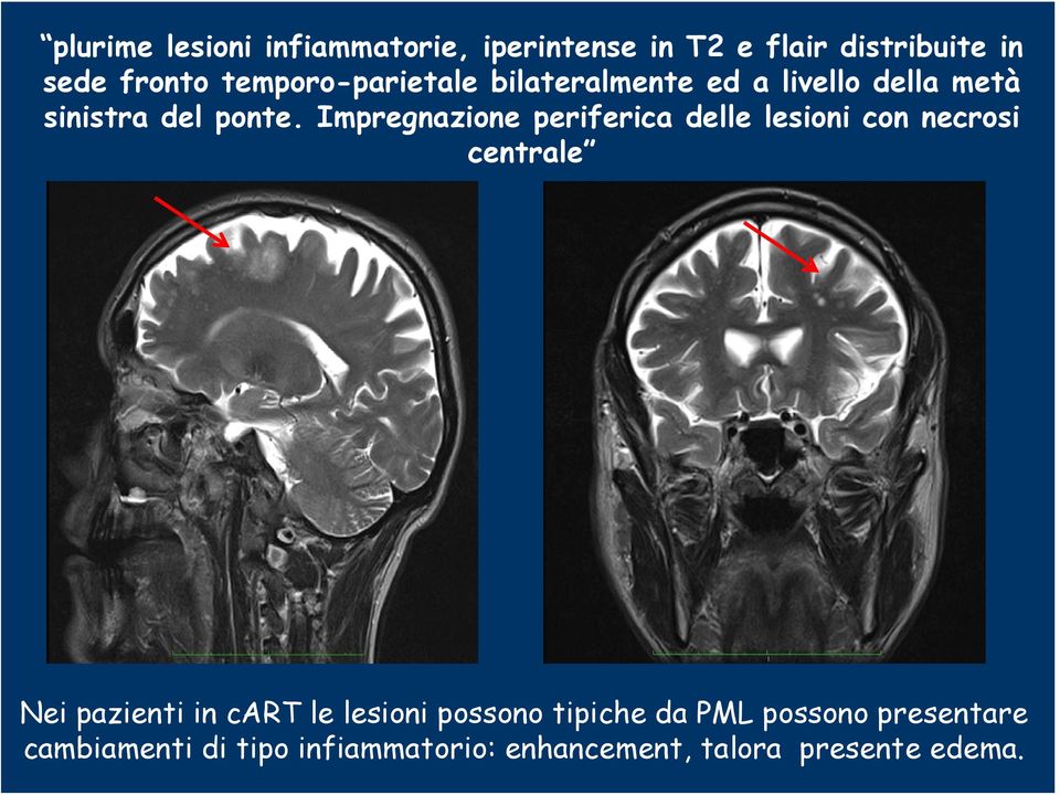 Impregnazione periferica delle lesioni con necrosi centrale Nei pazienti in cart le lesioni