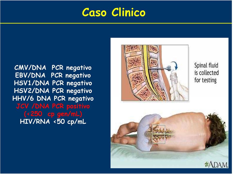 HHV/6 DNA PCR negativo JCV /DNA PCR positivo