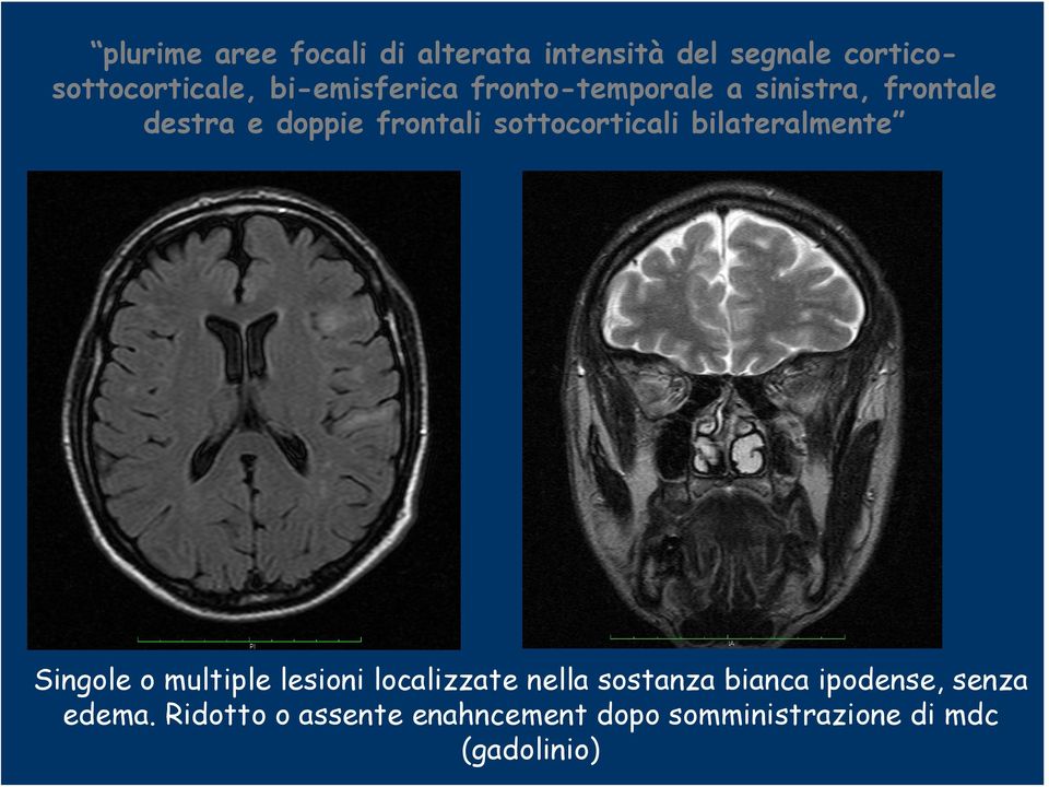 sottocorticali bilateralmente Singole o multiple lesioni localizzate nella sostanza