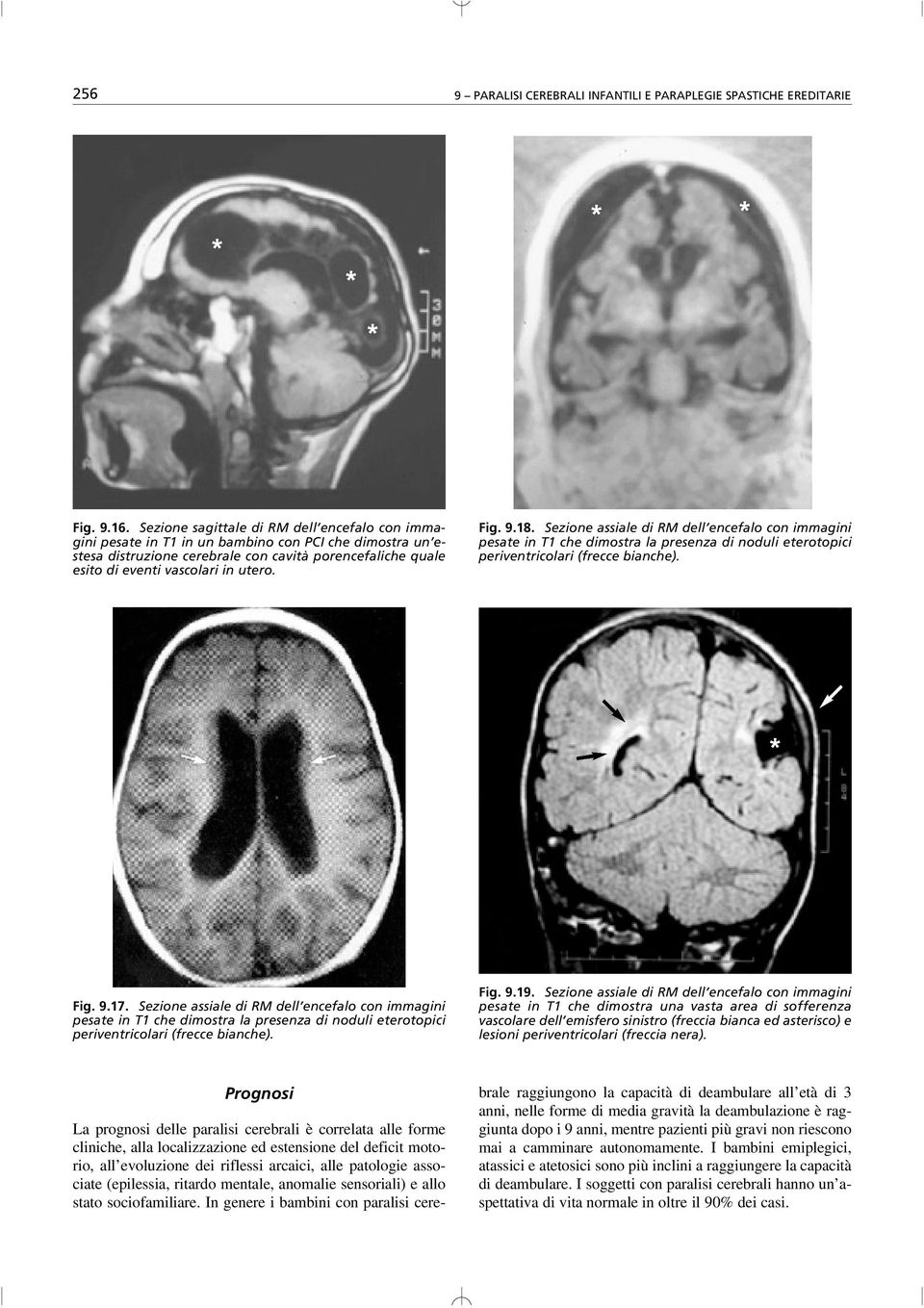 Fig. 9.18. Sezione assiale di RM dell encefalo con immagini pesate in T1 che dimostra la presenza di noduli eterotopici periventricolari (frecce bianche). * Fig. 9.17.