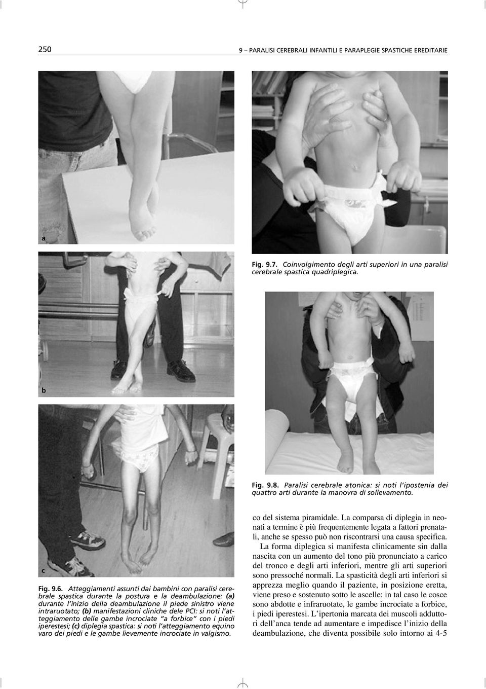 Atteggiamenti assunti dai bambini con paralisi cerebrale spastica durante la postura e la deambulazione: ( a ) durante l inizio della deambulazione il piede sinistro viene intraruotato; ( b )