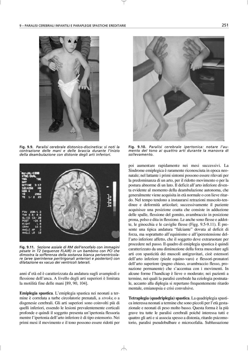 Sezione assiale di RM dell encefalo con immagini pesate in T2 (sequenze FLAIR) in un bambino con PCI che dimostra la sofferenza della sostanza bianca periventricolare (aree iperintense peritrigonali