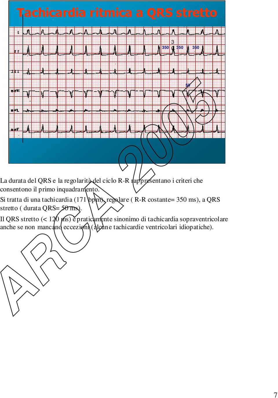 Si tratta di una tachicardia (171 bpm), regolare ( R-R costante= 350 ms), a QRS stretto ( durata QRS= 50 ms).