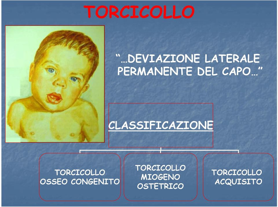 TORCICOLLO OSSEO CONGENITO