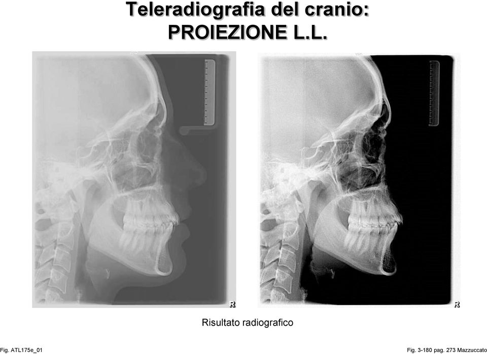 L. Risultato radiografico