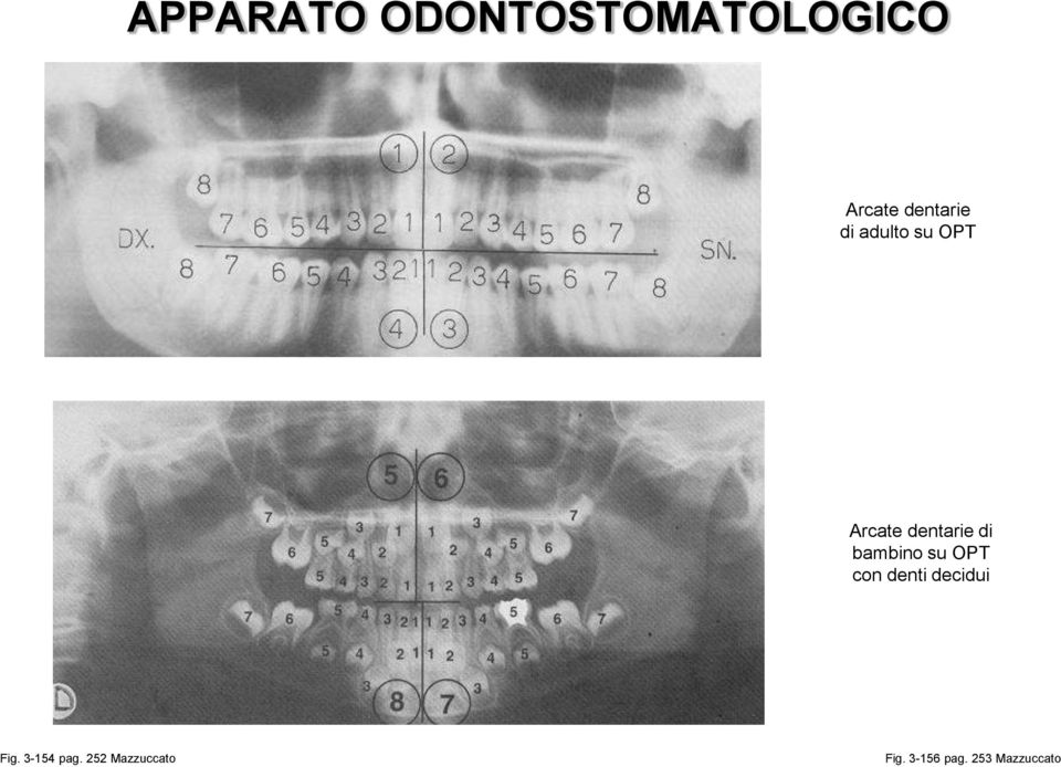 di bambino su OPT con denti decidui Fig.