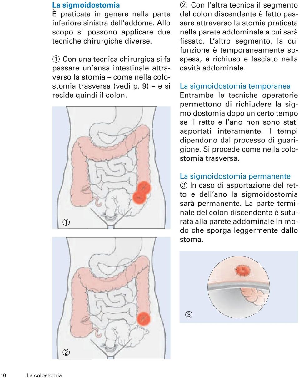 ➁ Con l altra tecnica il segmento del colon discendente è fatto passare attraverso la stomia praticata nella parete addominale a cui sarà fissato.