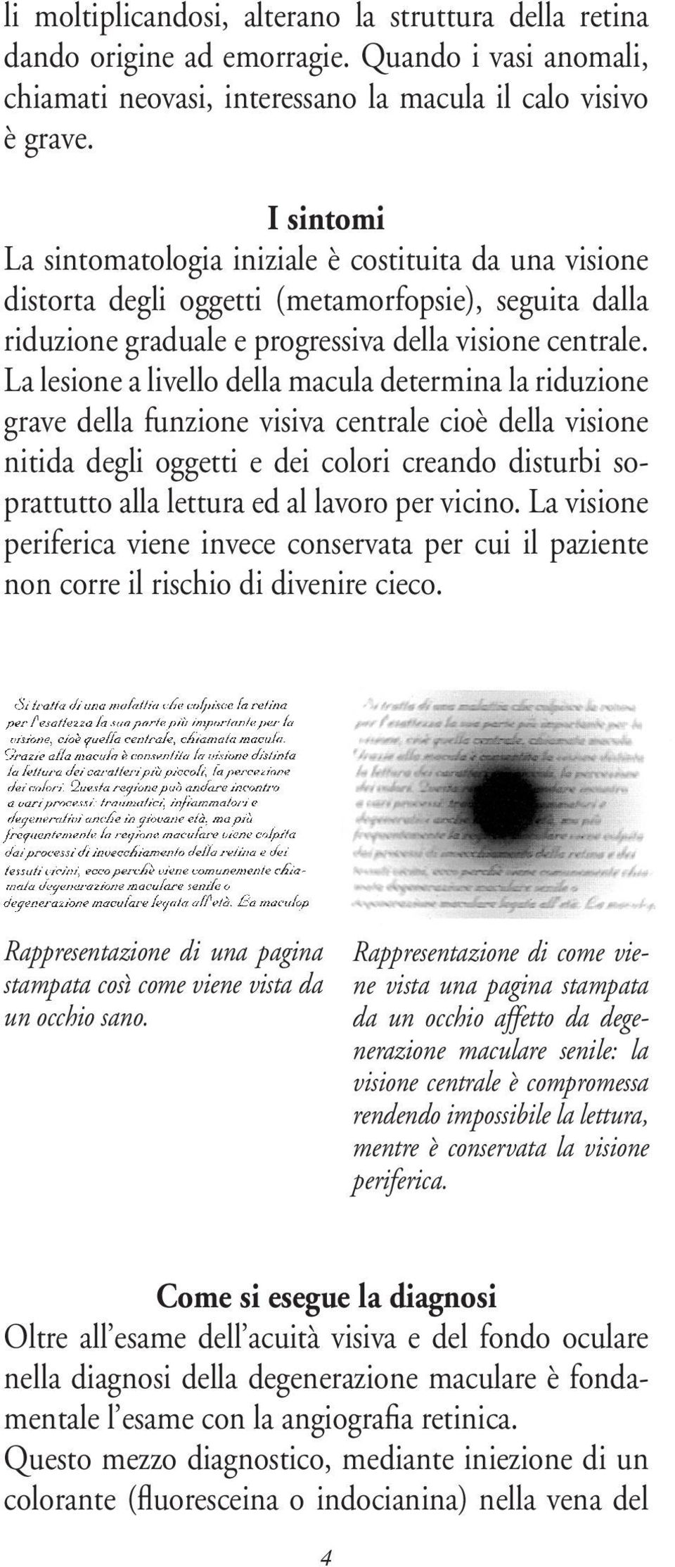 La lesione a livello della macula determina la riduzione grave della funzione visiva centrale cioè della visione nitida degli oggetti e dei colori creando disturbi soprattutto alla lettura ed al