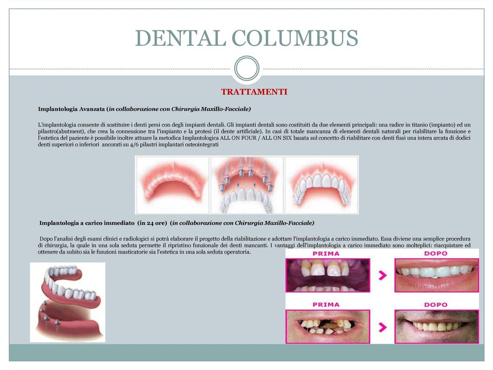 In casi di totale mancanza di elementi dentali naturali per riabilitare la funzione e l estetica del paziente èpossibile inoltre attuare la metodica Implantologica ALL ON FOUR / ALL ON SIXbasata sul