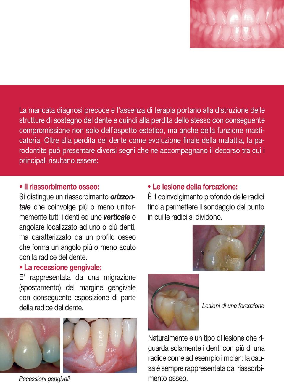 Oltre alla perdita del dente come evoluzione finale della malattia, la parodontite può presentare diversi segni che ne accompagnano il decorso tra cui i principali risultano essere: Il riassorbimento