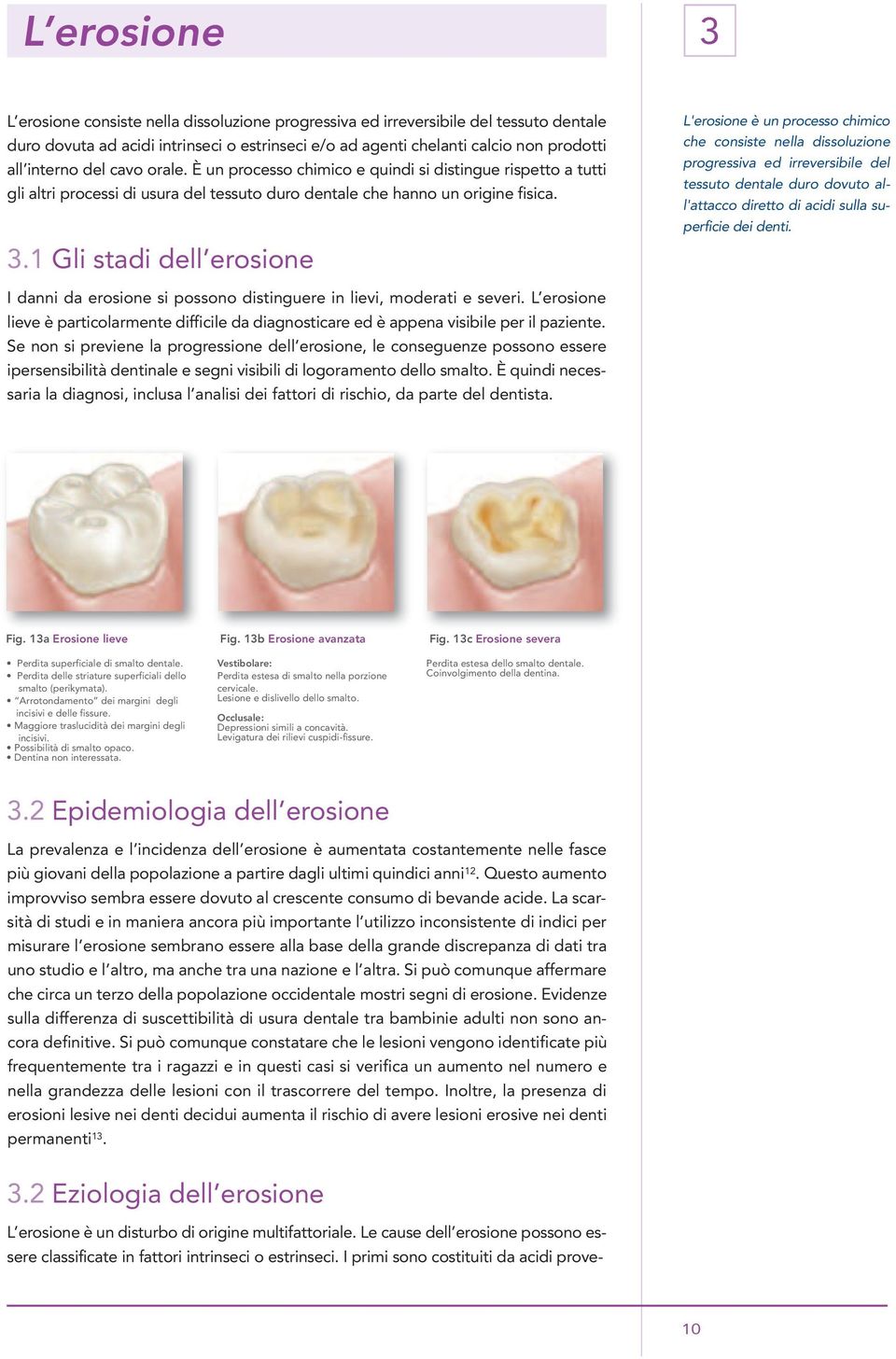 1 Gli stadi dell erosione L'erosione è un processo chimico che consiste nella dissoluzione progressiva ed irreversibile del tessuto dentale duro dovuto all'attacco diretto di acidi sulla superficie