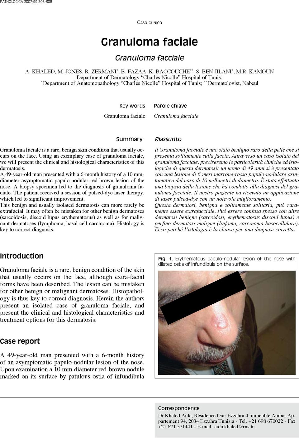 Dermatologist, Nabeul Key words Granuloma faciale Parole chiave Granuloma facciale Summary Granuloma faciale is a rare, benign skin condition that usually occurs on the face.