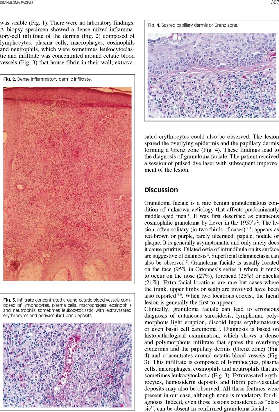 3) that house fibrin in their wall; extrava- Fig. 4. Spared papillary dermis or Grenz zone. Fig. 2. Dense inflammatory dermic infiltrate. sated erythrocytes could also be observed.