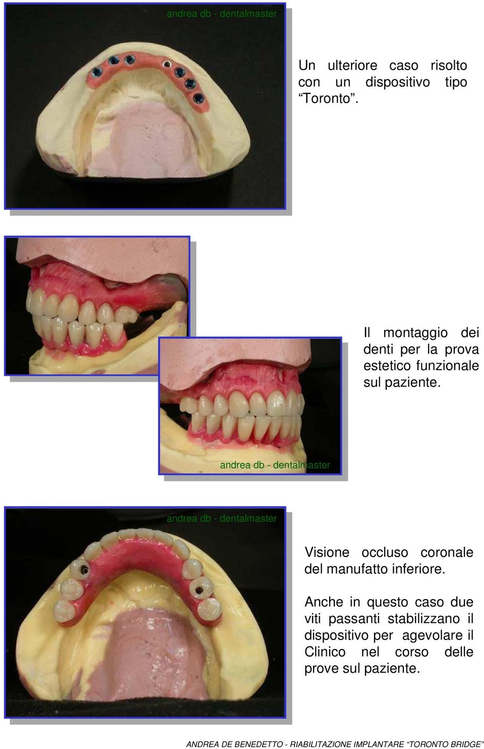 . Visione occluso coronale del manufatto inferiore.