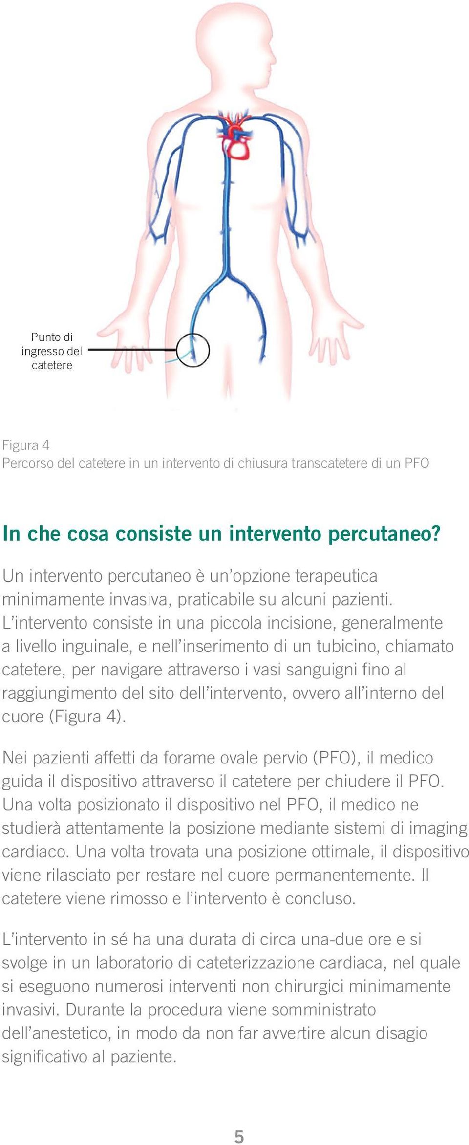 L intervento consiste in una piccola incisione, generalmente a livello inguinale, e nell inserimento di un tubicino, chiamato catetere, per navigare attraverso i vasi sanguigni fino al raggiungimento