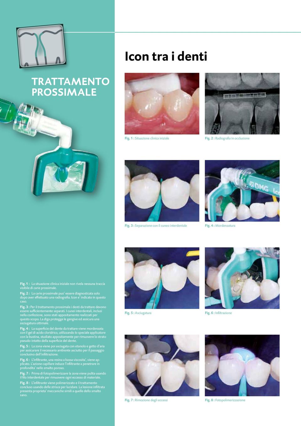 Icon e indicato in questo caso. Fig. 3 : Per il trattamento prossimale i denti da trattare devono essere sufficientemente separati.