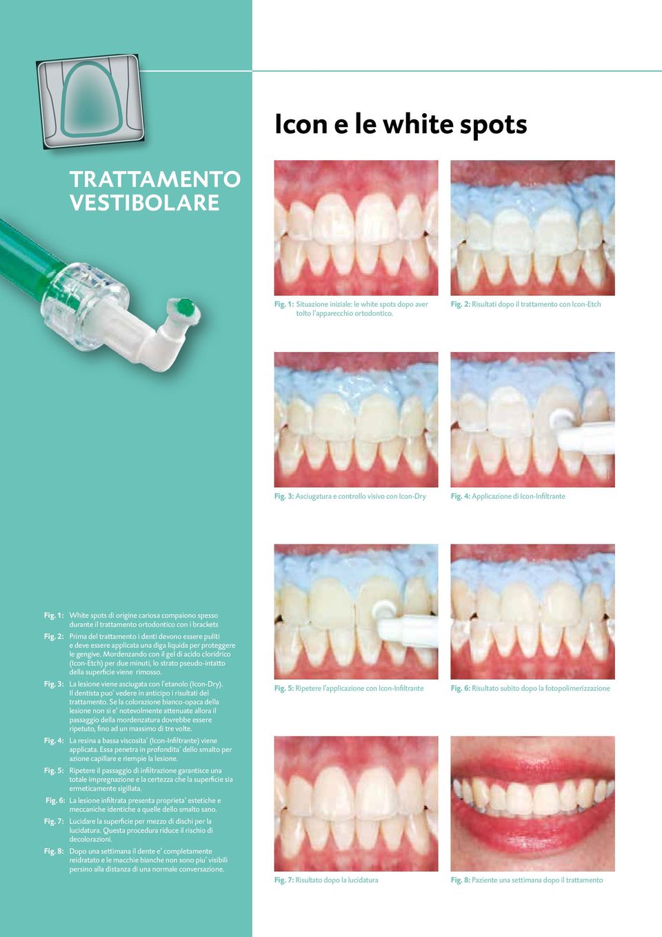 2: Prima del trattamento i denti devono essere puliti e deve essere applicata una diga liquida per proteggere le gengive.