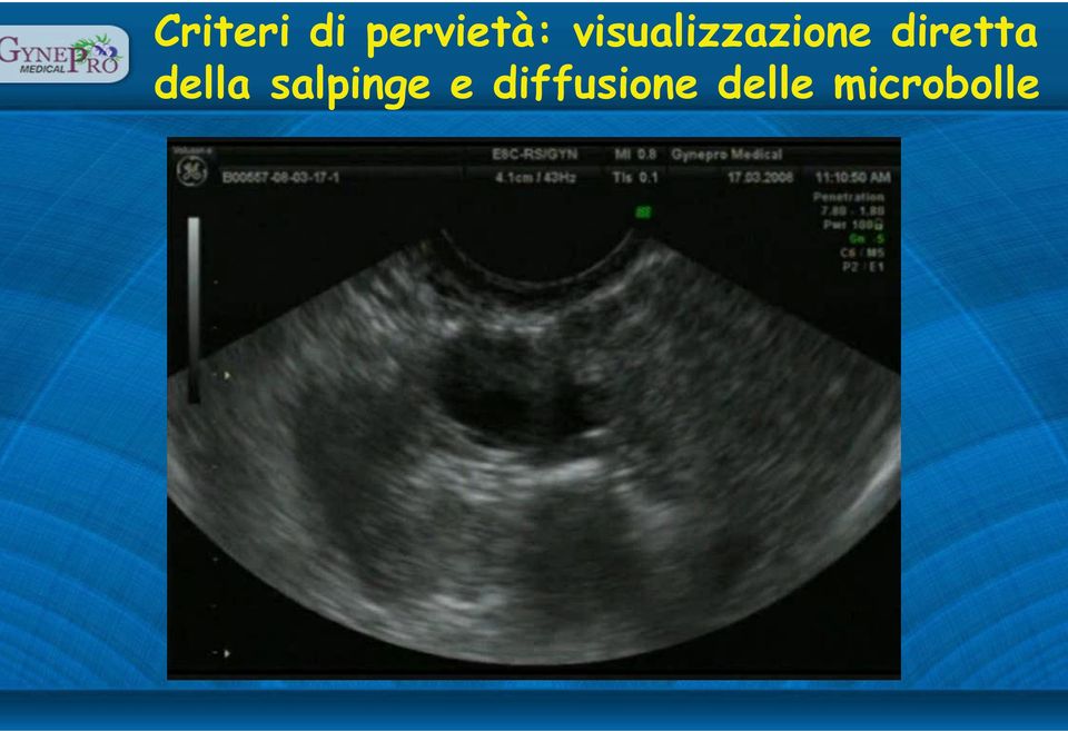 diretta della salpinge