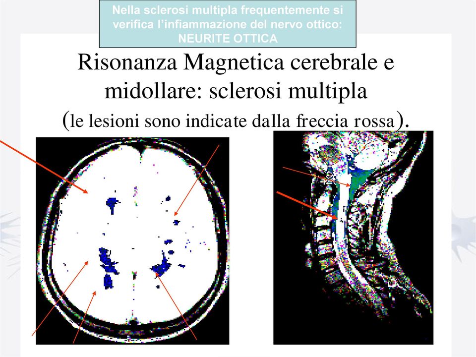 Risonanza Magnetica cerebrale e midollare: sclerosi