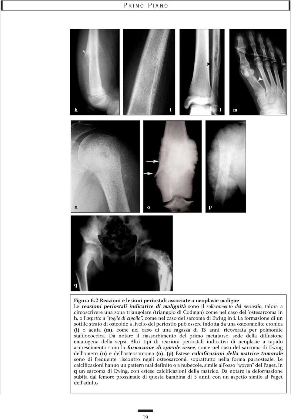 di Codman) come nel caso dell ostesarcoma in h, o l aspetto a foglie di cipolla, come nel caso del sarcoma di Ewing in i.