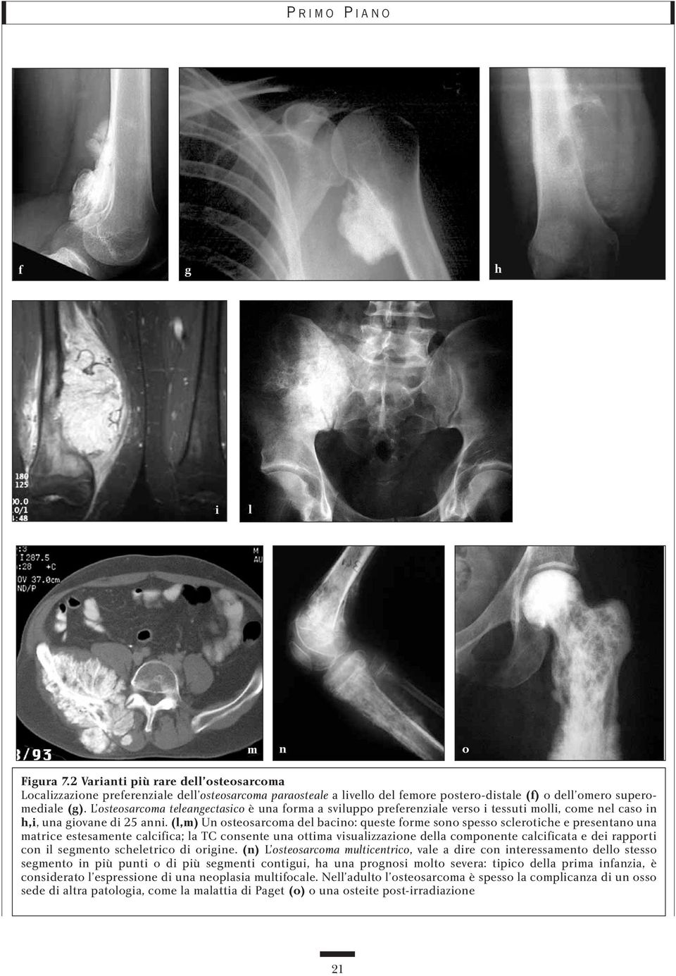 (l,m) Un osteosarcoma del bacino: queste forme sono spesso sclerotiche e presentano una matrice estesamente calcifica; la TC consente una ottima visualizzazione della componente calcificata e dei