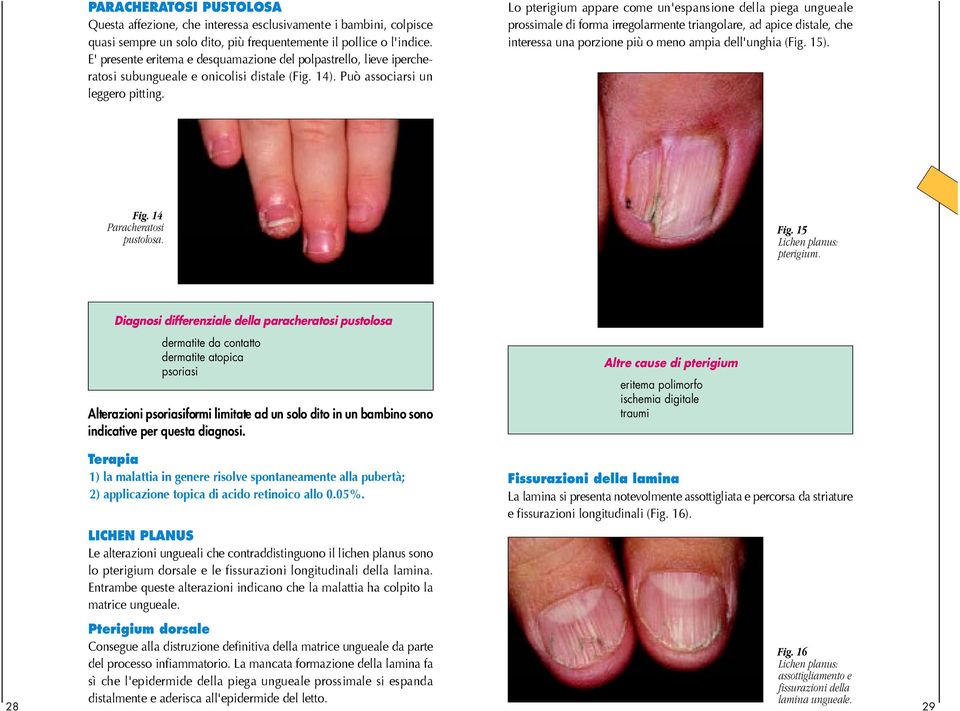 Lo pterigium appare come un'espansione della piega ungueale prossimale di forma irregolarmente triangolare, ad apice distale, che interessa una porzione più o meno ampia dell'unghia (Fig. 15). Fig.