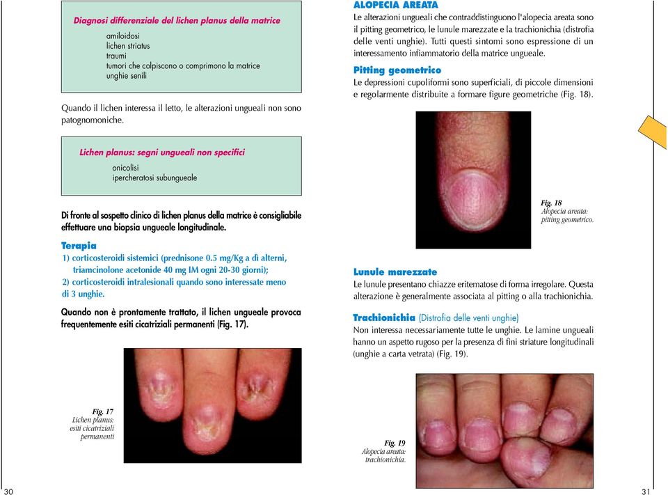 ALOPECIA AREATA Le alterazioni ungueali che contraddistinguono l'alopecia areata sono il pitting geometrico, le lunule marezzate e la trachionichia (distrofia delle venti unghie).