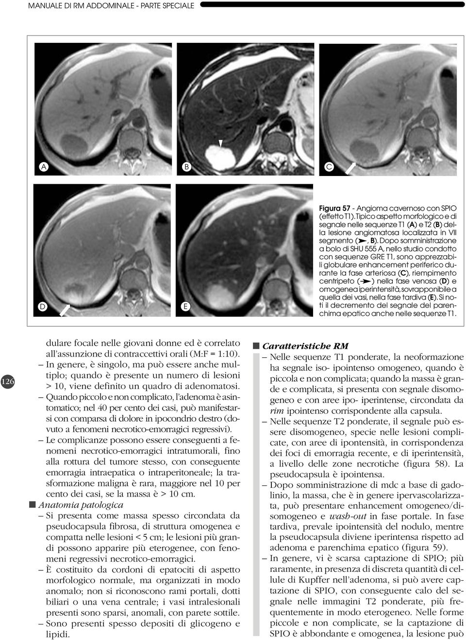 opo somministrazione a bolo di SHU 555 A,nello studio condotto con sequenze GRE T1, sono apprezzabili globulare enhancement periferico durante la fase arteriosa (C), riempimento centripeto ( ) nella