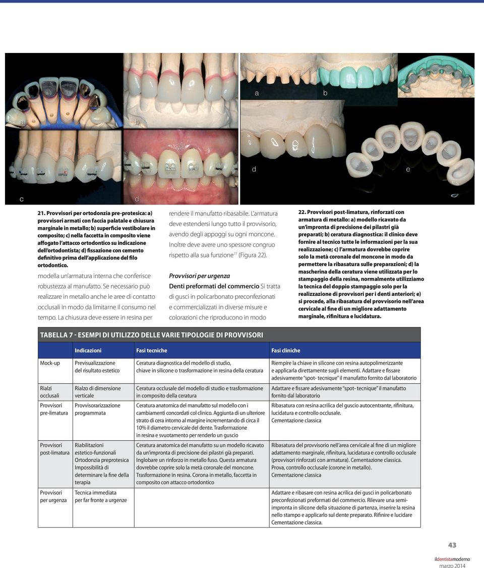 modella un armatura interna che conferisce robustezza al manufatto. Se necessario può realizzare in metallo anche le aree di contatto occlusali in modo da limitarne il consumo nel tempo.