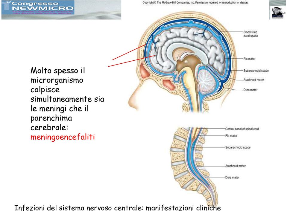 parenchima cerebrale: meningoencefaliti