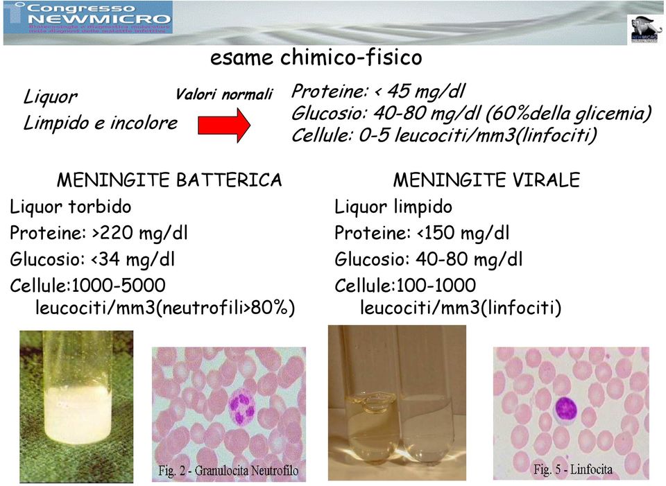 Proteine: >220 mg/dl Glucosio: <34 mg/dl Cellule:1000-5000 leucociti/mm3(neutrofili>80%) MENINGITE