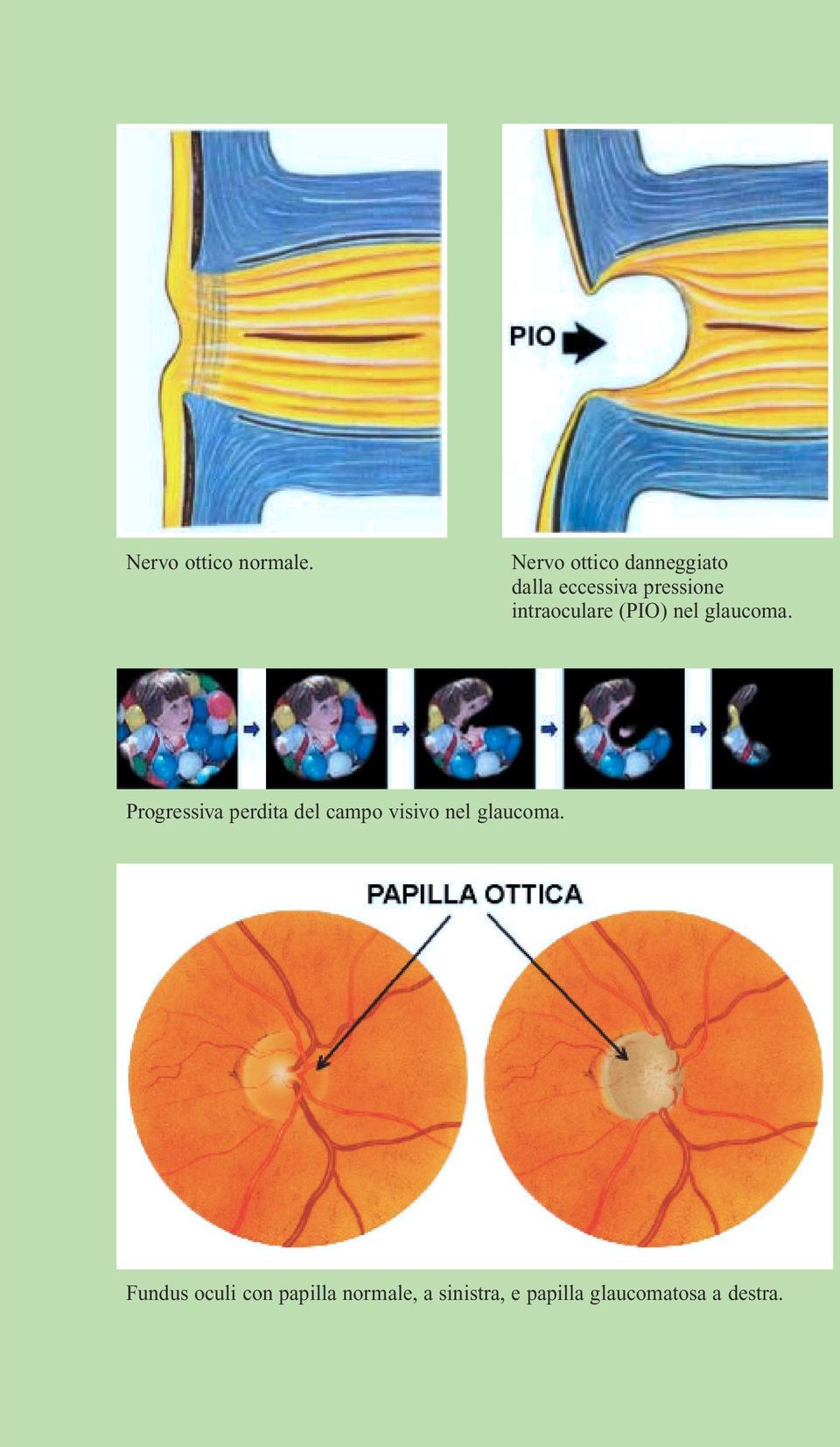 intraoculare (PIO) nel glaucoma.