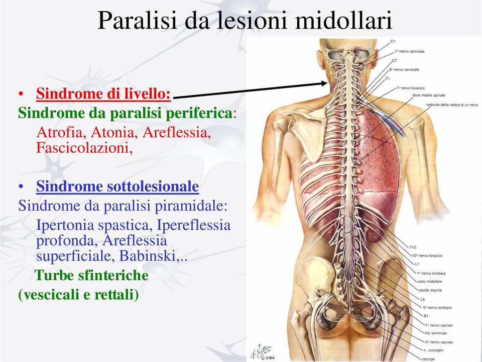 sottolesionale Sindrome da paralisi piramidale: Ipertonia spastica,