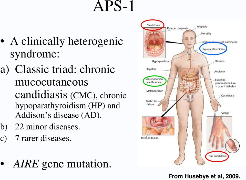 hypoparathyroidism (HP) and Addison s disease (AD).