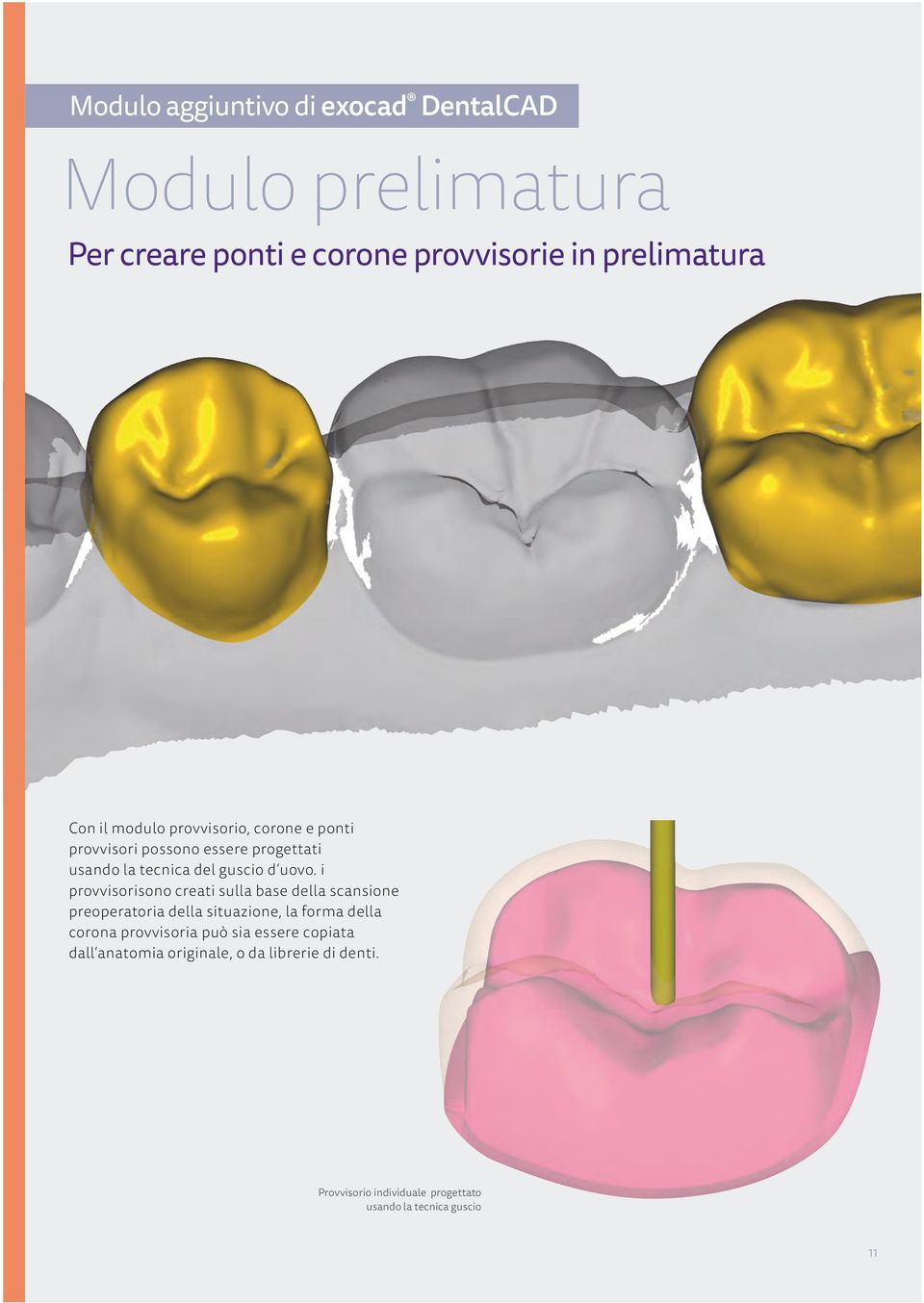 i provvisorisono creati sulla base della scansione preoperatoria della situazione, la forma della corona provvisoria