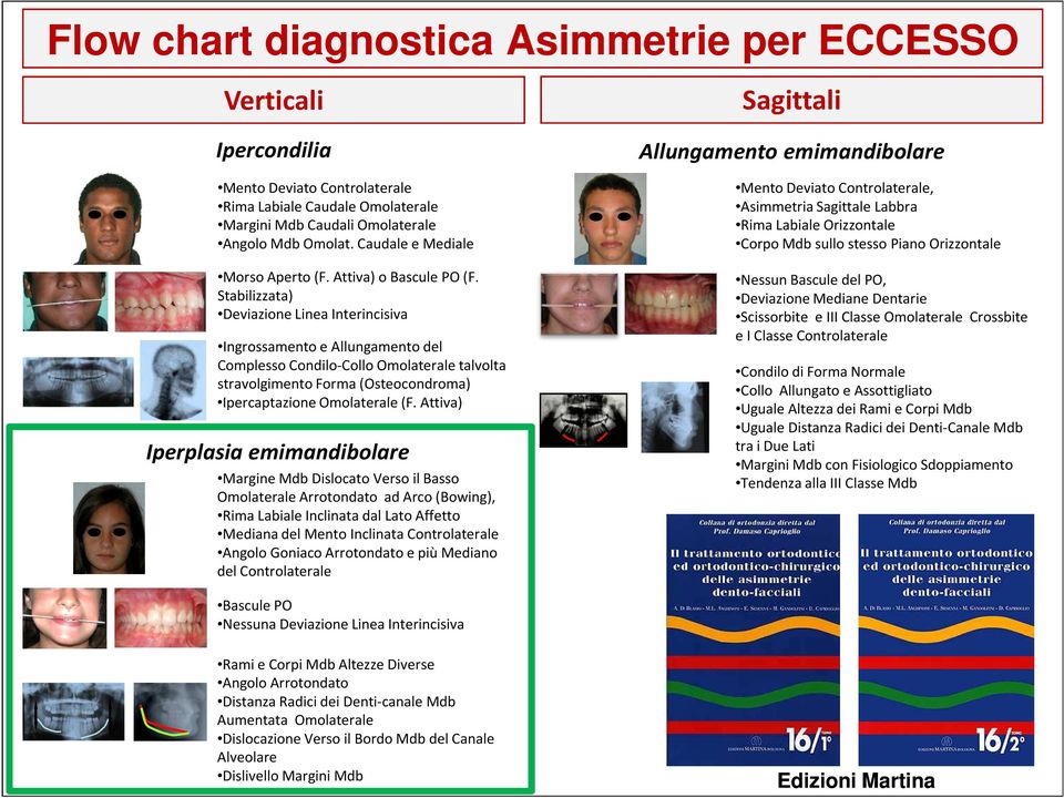 Stabilizzata) Deviazione Linea Interincisiva Ingrossamento e Allungamento del Complesso Condilo-Collo Omolateraletalvolta stravolgimento Forma (Osteocondroma) Ipercaptazione Omolaterale(F.