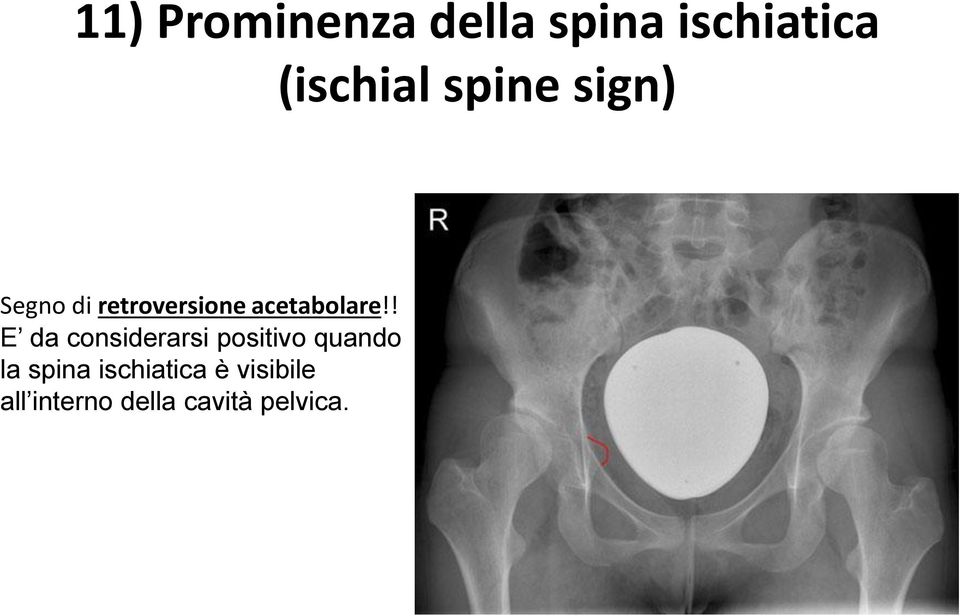 ! E da considerarsi positivo quando la spina