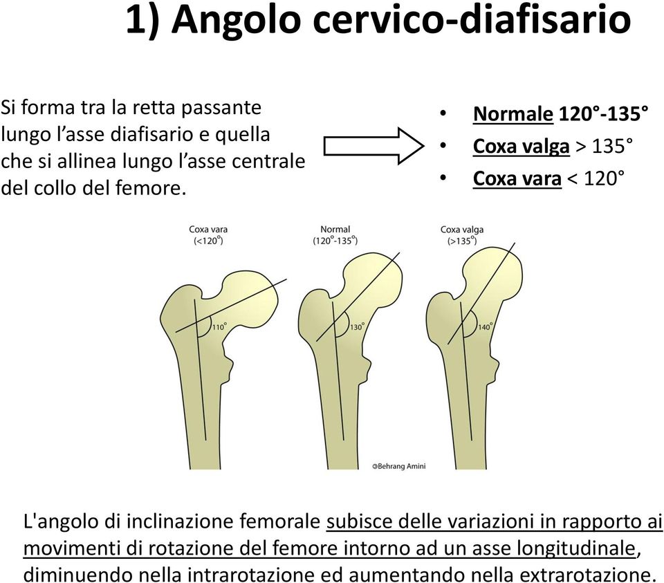 Normale 120-135 Coxa valga > 135 Coxa vara < 120 L'angolo di inclinazione femorale subisce delle