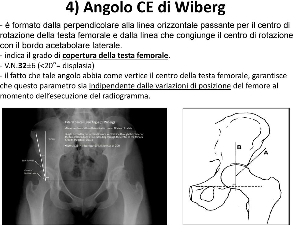 - indica il grado di copertura della testa femorale. - V.N.