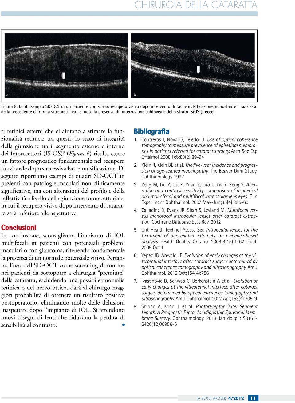 interruzione subfoveale dello strato IS/OS (frecce) ti retinici esterni che ci aiutano a stimare la funzionalità retinica: tra questi, lo stato di integrità della giunzione tra il segmento esterno e