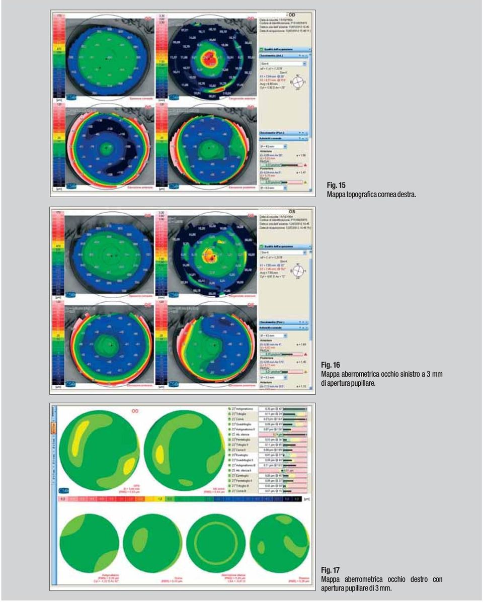 di apertura pupillare. Fig.
