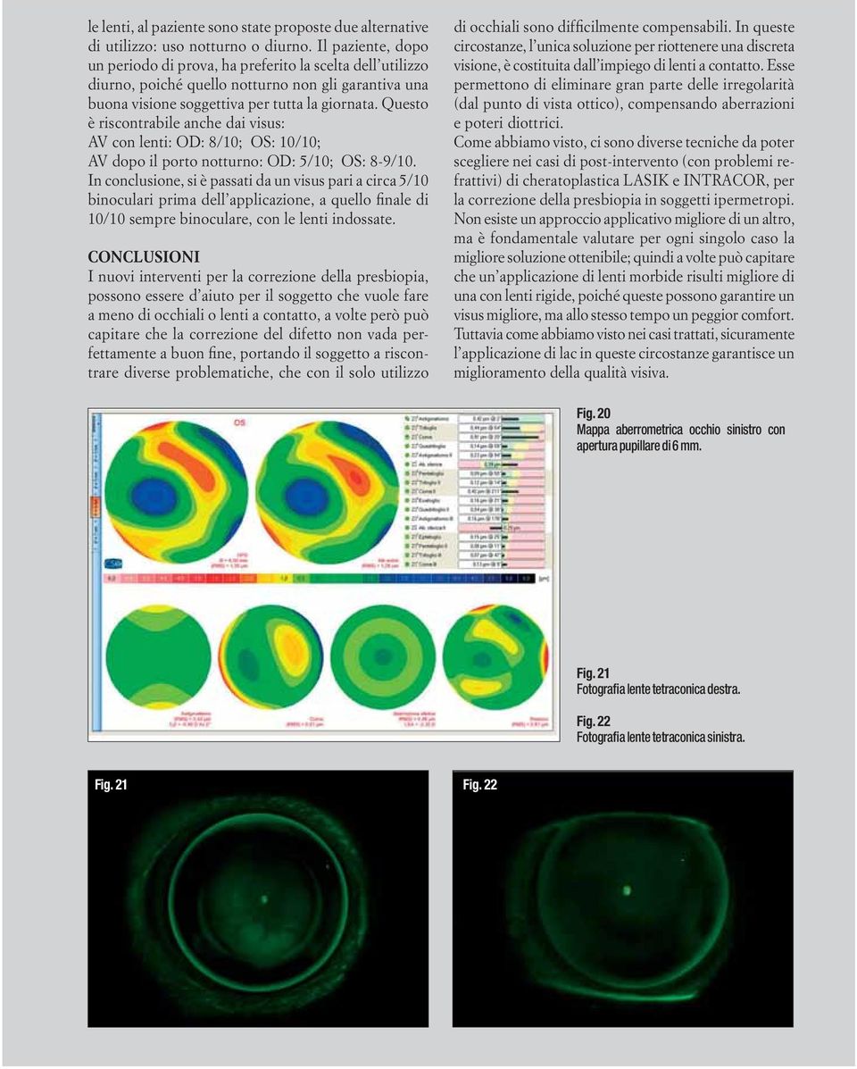 Questo è riscontrabile anche dai visus: AV con lenti: OD: 8/10; OS: 10/10; AV dopo il porto notturno: OD: 5/10; OS: 8-9/10.