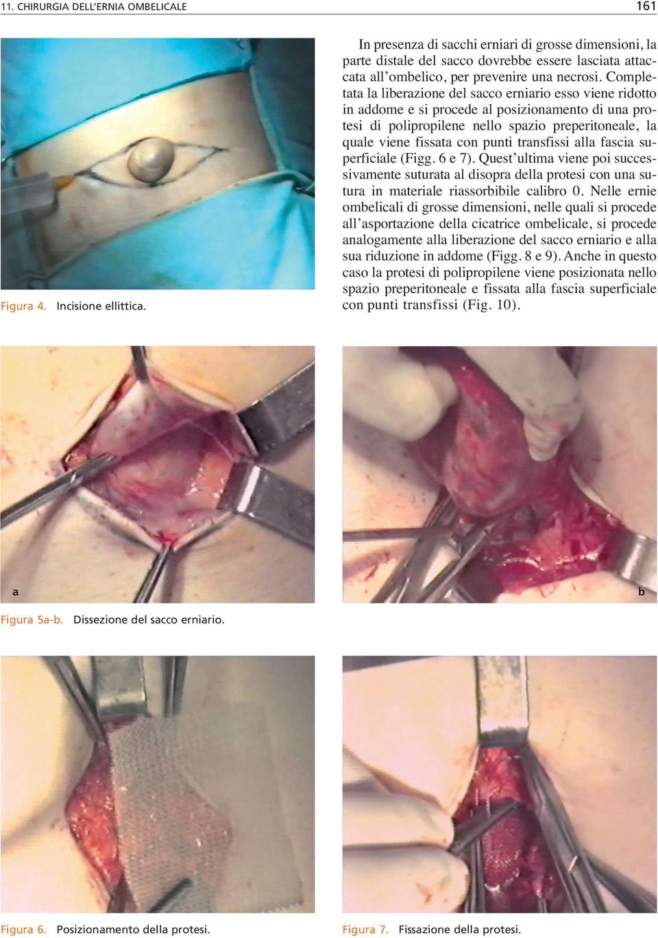 Completata la liberazione del sacco erniario esso viene ridotto in addome e si procede al posizionamento di una protesi di polipropilene nello spazio preperitoneale, la quale viene fissata con punti