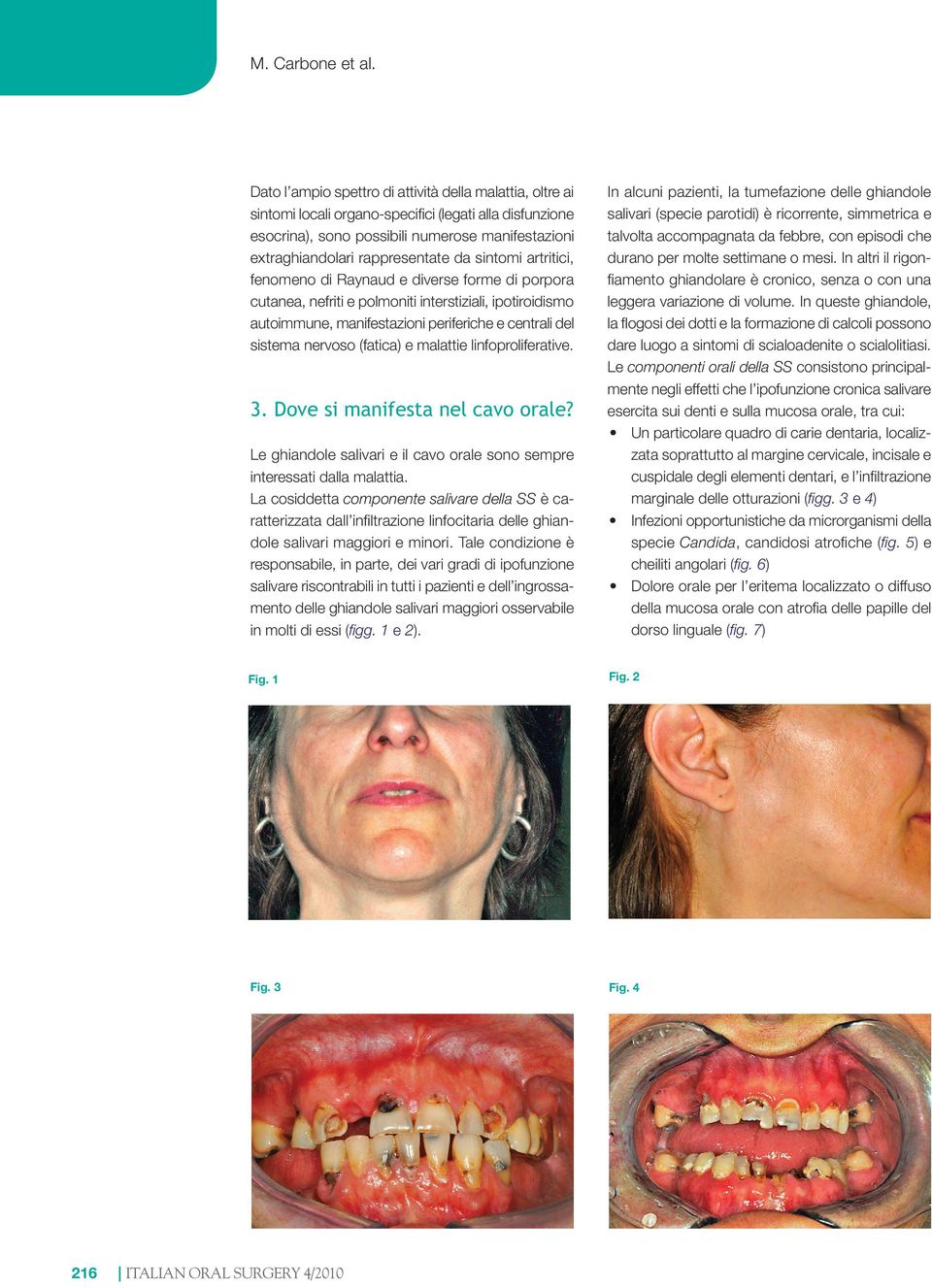 sintomi artritici, fenomeno di Raynaud e diverse forme di porpora cutanea, nefriti e polmoniti interstiziali, ipotiroidismo autoimmune, manifestazioni periferiche e centrali del sistema nervoso