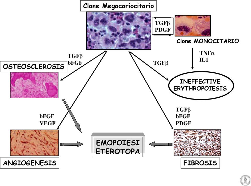 TNFα IL1 INEFFECTIVE ERYTHROPOIESIS bfgf VEGF