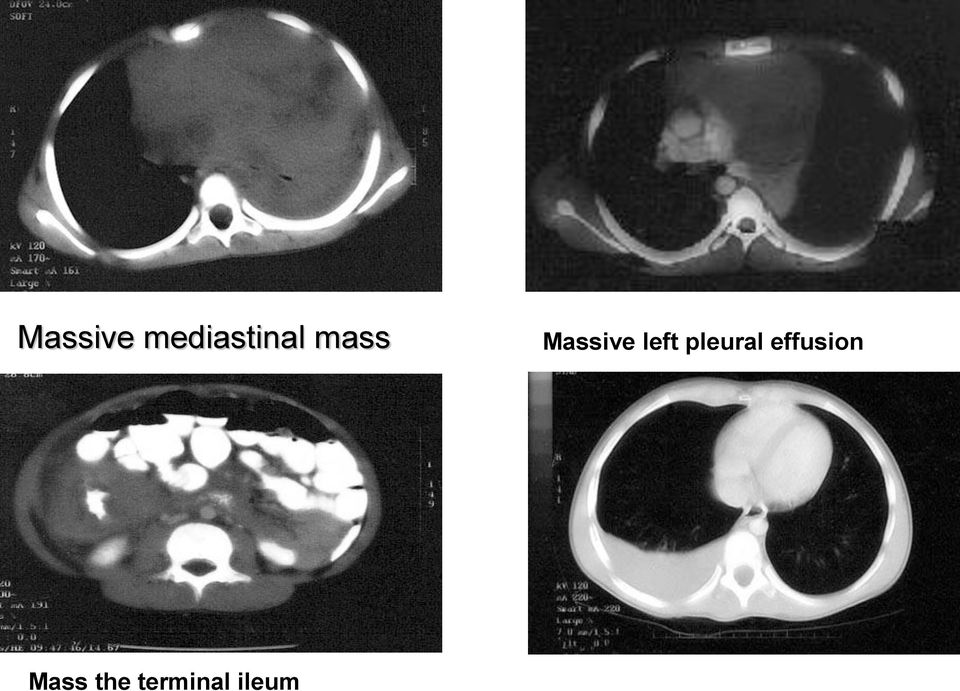 pleural effusion