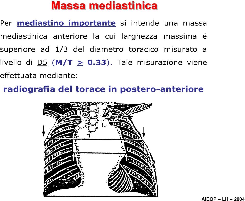 diametro toracico misurato a livello di D5 (M/T > 0.33).