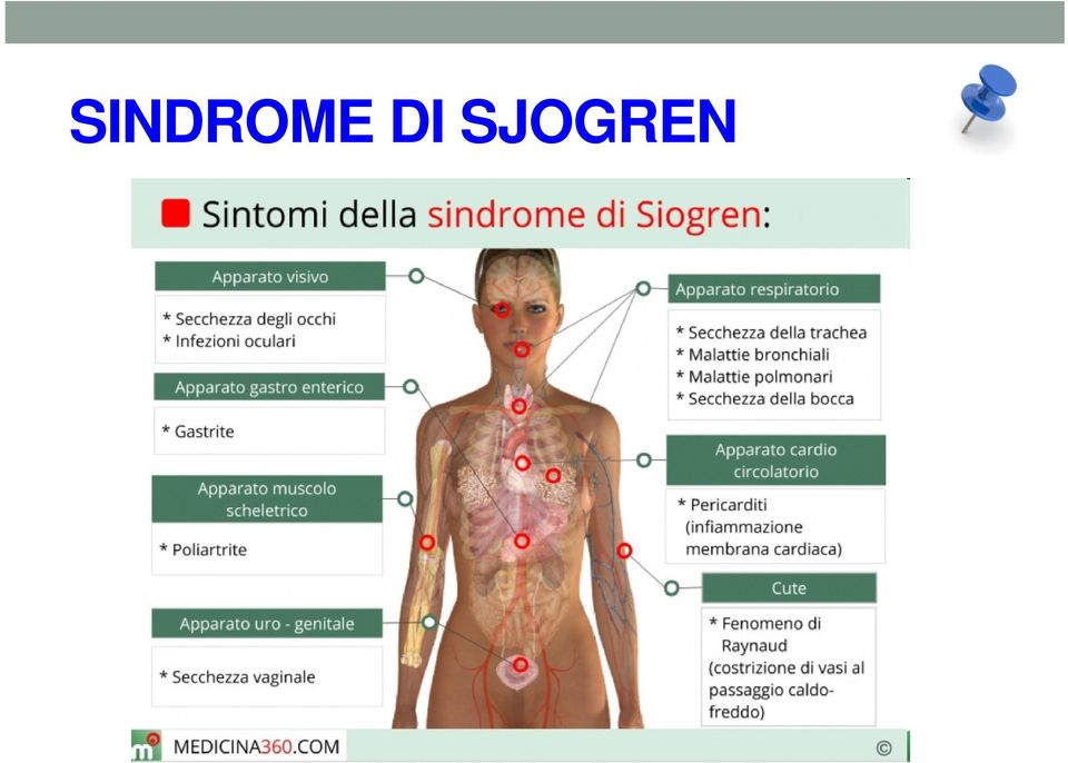 SJOGREN